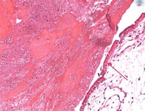 A Case Of Dande Showing Intervillous Fibrinoid Necrosis With Normal Download Scientific Diagram