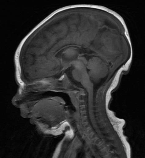 Nurturing Noah's Noggin: Agenesis of the Corpus Callosum Diagnosis