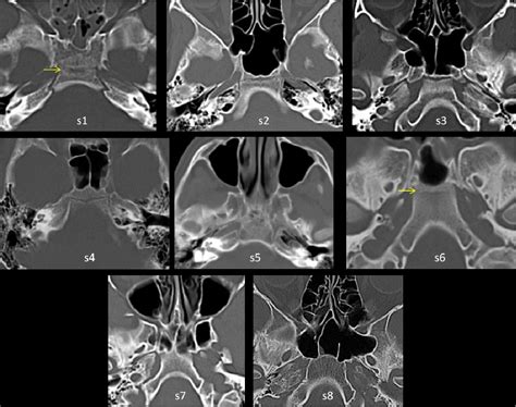 Figure 6 From The Ossification Process Of The Occipital Bone And Normal Variants Evaluation By