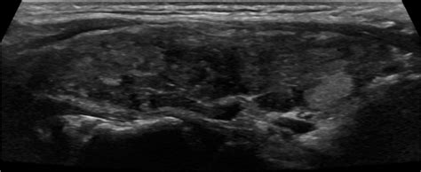 Sonographic Features Of Diffuse Hashimoto Thyroiditis Determining