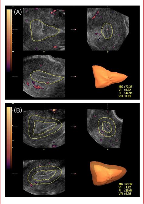 Figure From Relationship Between Endometrial And Subendometrial Blood