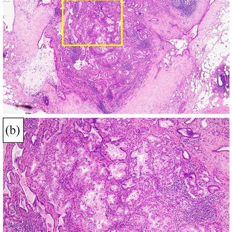 Hematoxylin And Eosin Staining Of Paraffin Embedded Lymph Node Specimen