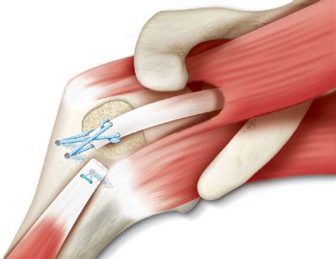 Superior Capsular Reconstruction Of The Shoulder The Abc Arthroscopic