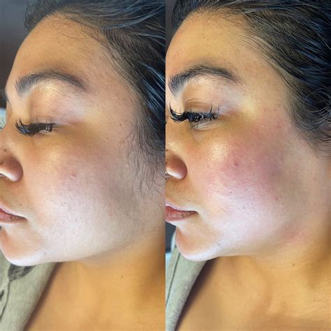 Patient Hydrafacial Before After Photos Dr Courtney