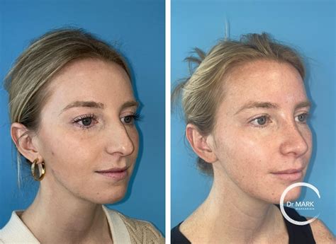 Rhinoplasty Before And After Images Dr Markarian