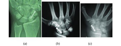 A Preoperative Pa Wrist X Ray Of Non United Scaphoid Fracture After Download Scientific