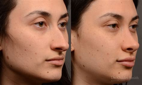 Dr Oaklry Smith Top Rhinoplasty In Toronto