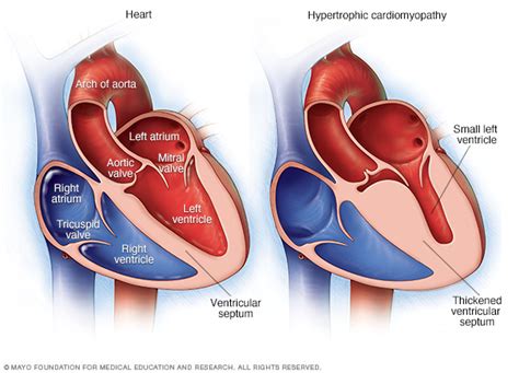 Cardiomyopathy Disease Reference Guide