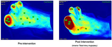 Perfusion Assessment in Critical Limb Ischemia - American College of ...