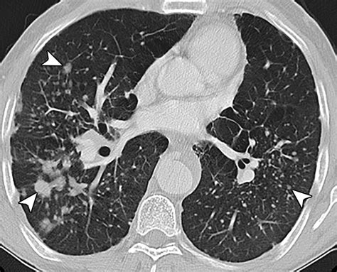 Thoracic Manifestations Of Rheumatoid Arthritis Radiographics