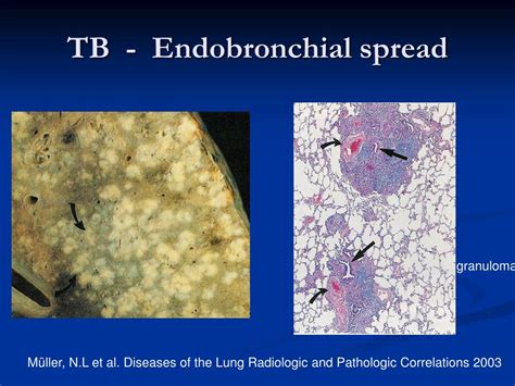 Ppt Tuberculosis What Is Essential To Know Powerpoint Presentation Id 3413206