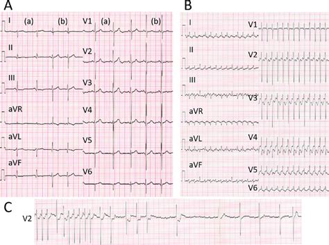 Twelve Lead Surface Electrocardiogram ECG A Baseline ECG Showing