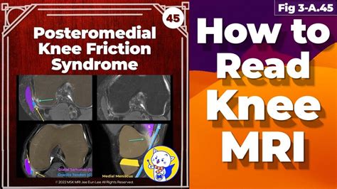 Fig 3 A45 Posteromedial Knee Friction Syndrome Youtube