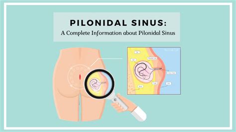 Pilonidal Sinus: A Complete Information about Pilonidal Sinus - Shah ...