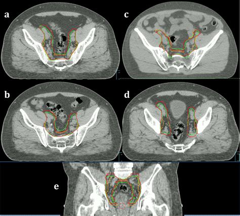 Consensus Guidelines And Contouring Atlas For Pelvic Node Delineation In Prostate And Pelvic