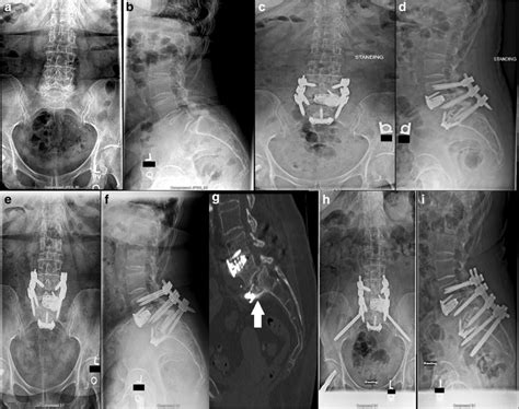 A Anteroposterior Ap And B Lateral Plain Radiographs Taken Before