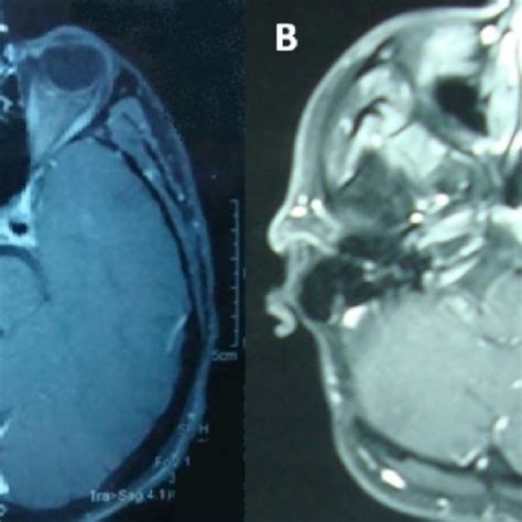 Post Operative Mri Shows Total Resection Of Tumor With No Detectable