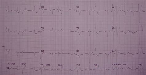 Ventricular Ectopics Couplets All About Cardiovascular System And Disorders