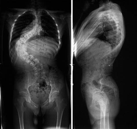 Standing Anteroposterior And Lateral Radiographs Of The Preoperation