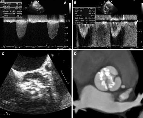 Current Management Of Calcific Aortic Stenosis Circulation Research