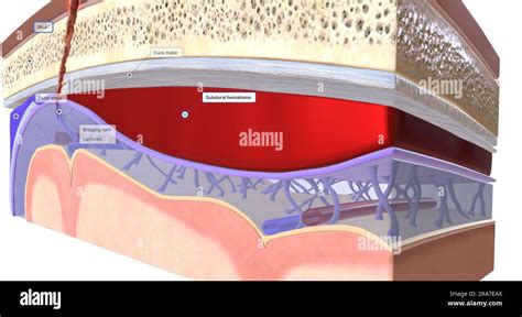 The Blood That Collects Between The Dura Mater And The Arachnoid Mater