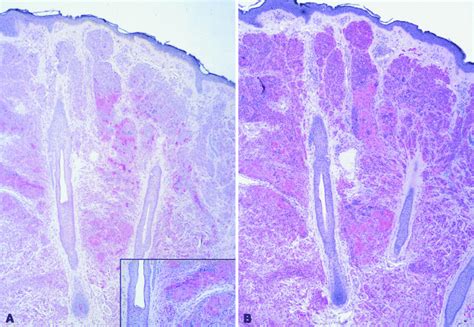 Preferential Labeling Of Type C Nevus Cells And Nevic Corpuscles Download Scientific Diagram