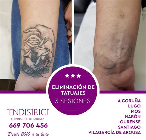 Láser para quitar tatuajes en A Coruña Tendistrict