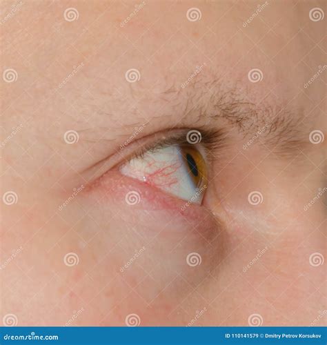 Eye, injury, blood vessels stock image. Image of bloodshot - 110141579