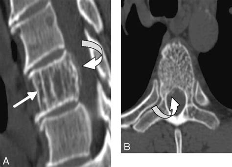 Vertebral Hemangioma Hemangioma Vertebral Mri Online