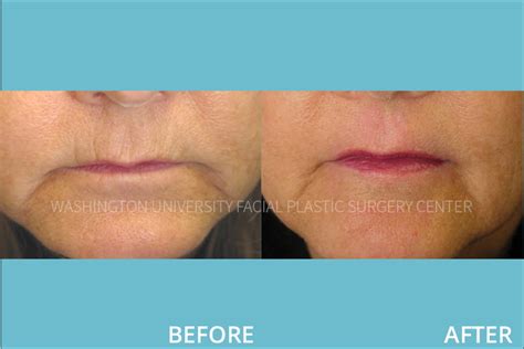 Before And After Facial Plastic Surgery Center Washington