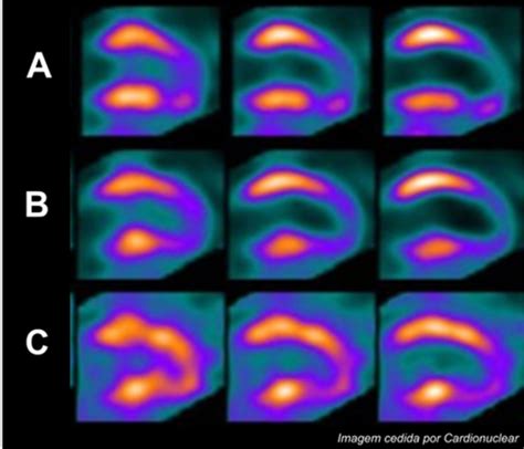 Assessing Myocardial Viability In Clinical Practice Abc Imaging