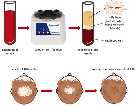 Using Platelet Rich Plasma To Treat Hair Loss Sure Hair International