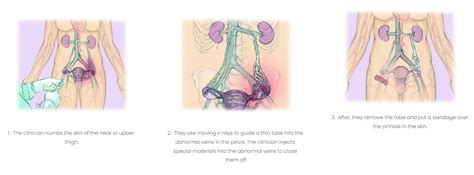 Pelvic Congestion Syndrome Symptoms Risks And Treatment Options