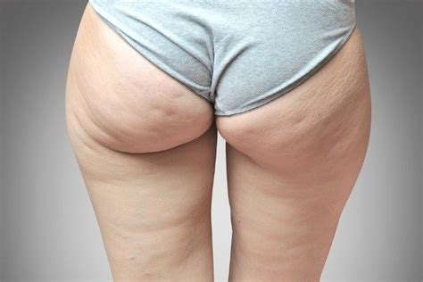 8 Tips On How To Hide Cellulite Healthtian