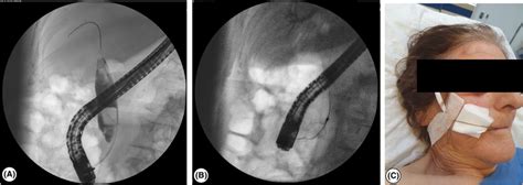 A Cholangiography With Choledocholithiasis B Basket With The Download Scientific Diagram