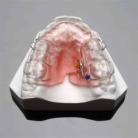 Asymmetric Expansion Appliance Americanortho