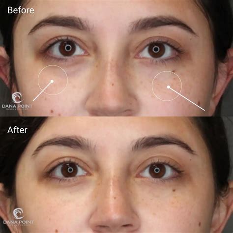 Dermal Filler Women Before And After Dana Point Dermatology