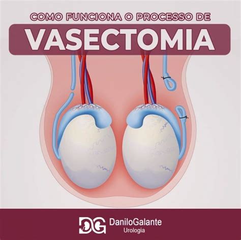 Como Funciona O Processo De Vasectomia