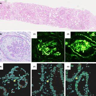 Representative pictures obtained from renal biopsy. (A,B) Renal biopsy ...