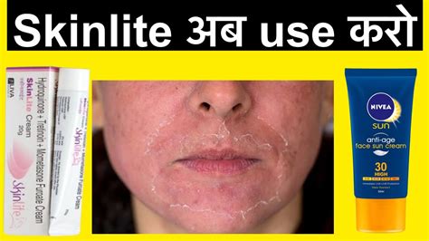 Skinlite Cream Review How To Use Skinlite Cream Youtube