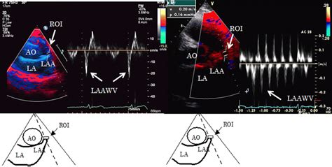 Relevance Of Transthoracic Left Atrial Appendage Wall Velocity