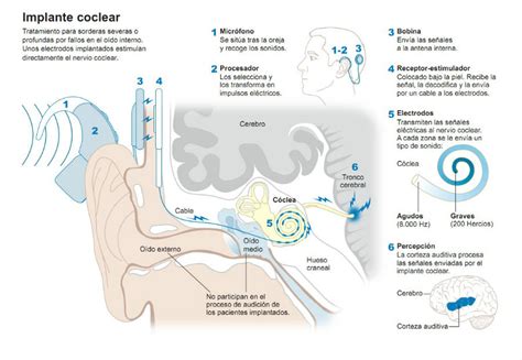 ¿qué Tengo Que Saber Si Quiero Ponerme Un Implante Coclear