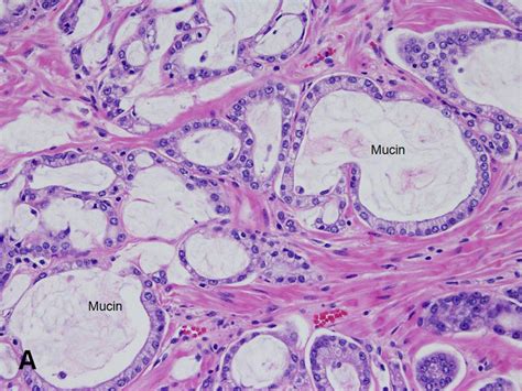 American Urological Association Prostatic Adenocarcinoma General