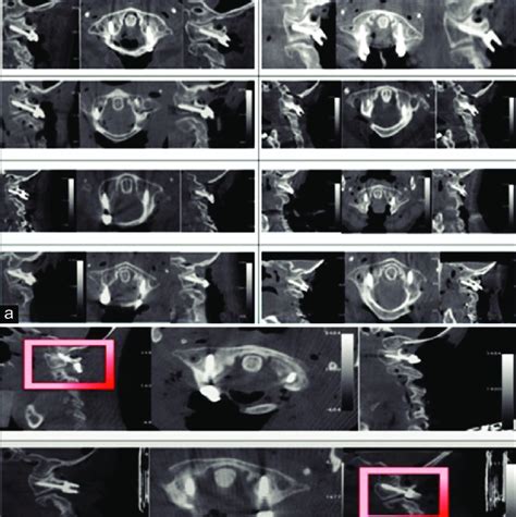 Images Demonstrating Atlas Lateral Mass Instrumentation In Ten Download Scientific Diagram