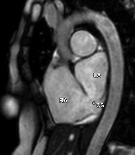 Imaging Of The Coronary Sinus Normal Anatomy And Congenital