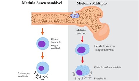 Mieloma múltiplo o que é sintomas e tratamentos RevistaOnlineABRALE