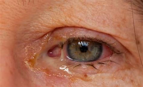 Excessive Eye Boogers: Causes, Types and Treatment – EYExan.com