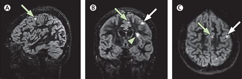 Grey Matter Pathology In Multiple Sclerosis The Lancet Neurology