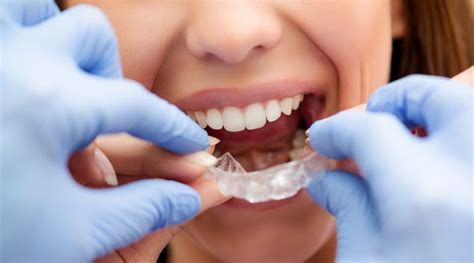 Ortodoncia Removible Ventajas E Inconvenientes Estudi Dental Barcelona