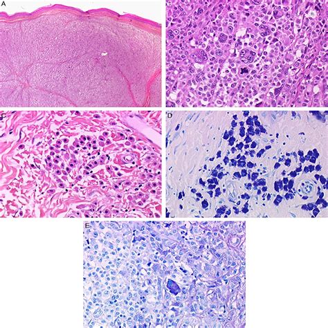 Malignant Transformation of Mastocytoma Developed on Skin Ma... : The ...